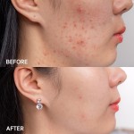 KEM TRỊ MỤN GIẢM NHỜN EUCERIN PRO ACNE SOLUTION 40ml