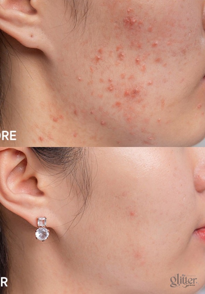 KEM TRỊ MỤN GIẢM NHỜN EUCERIN PRO ACNE SOLUTION 40ml