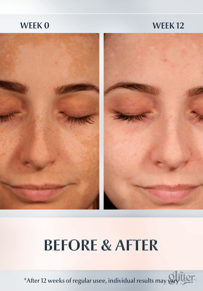 TINH CHẤT TRỊ NÁM EUCERIN ULTRA WHITE SPOTLESS 5ml 